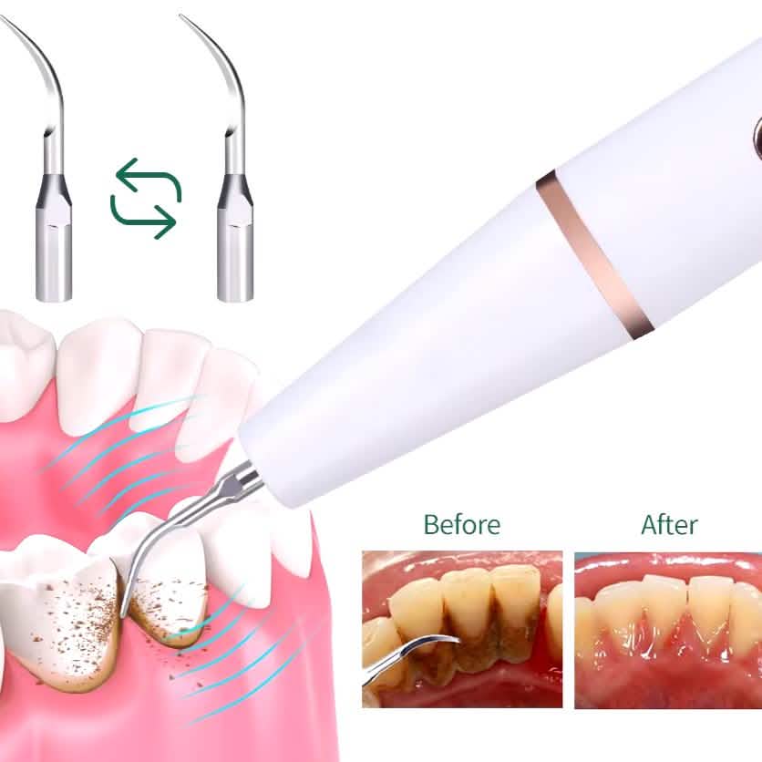 Advanced Electric Teeth Cleaning Tool Powerful Calculus Remover & Tartar Eraser