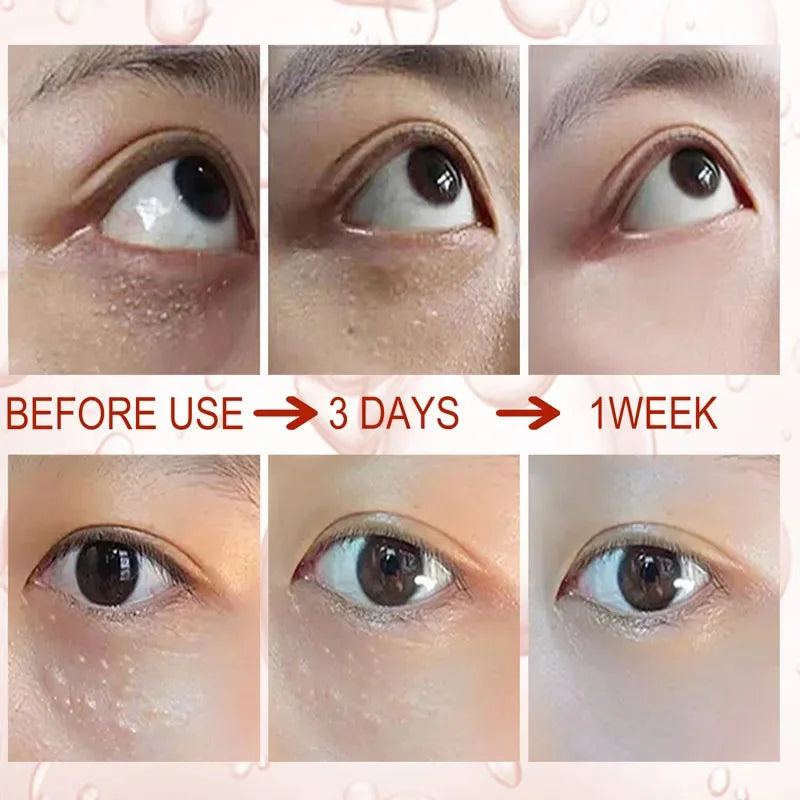 Fat Granules Removal Eye Serum Eye Milia Repair Treatment Products Wrinkle Lifting Moisturizing Anti-Puffiness Korean Skin Care