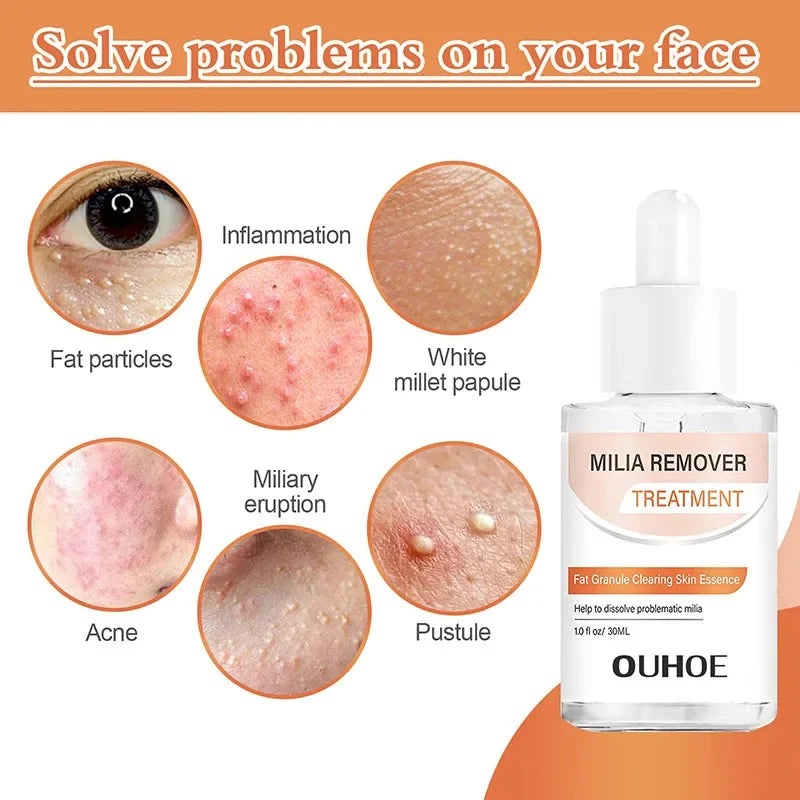 Fat Granules Removal Eye Serum Eye Milia Repair Treatment Products Wrinkle Lifting Moisturizing Anti-Puffiness Korean Skin Care