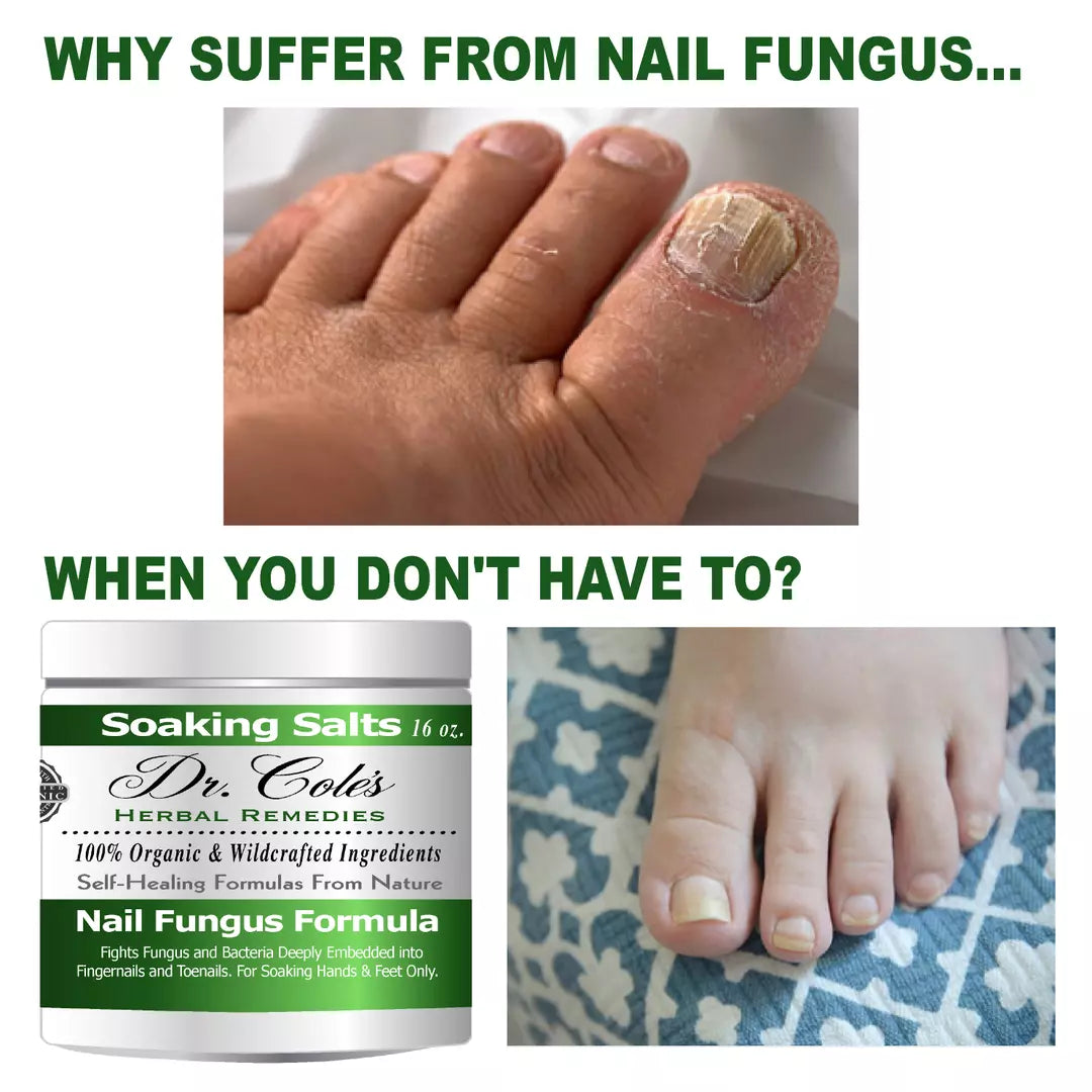 13 - Fórmula de Sales Orgánicas para Hongos en las Uñas del Dr. Cole